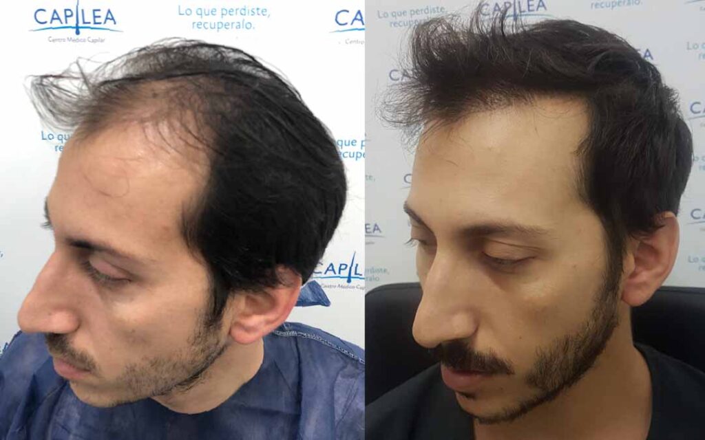 casos reales capilea antes y despues